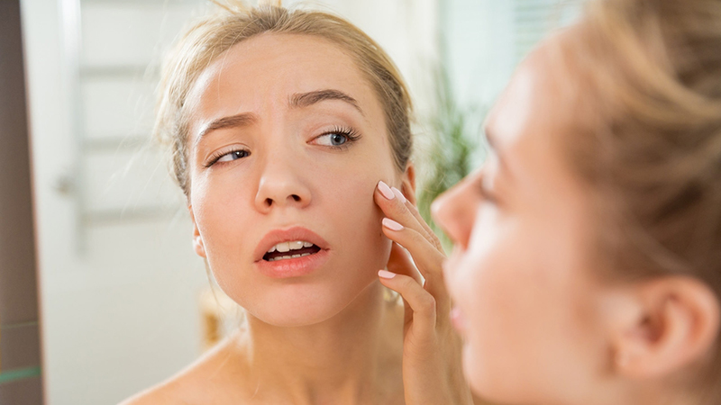 Mụn trứng cá đỏ (Rosacea) có đáng sợ như các nàng vẫn nghĩ?