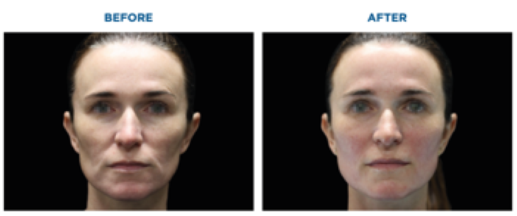 Sự cải thiện làn da trước và sau khi sử dụng EMFACE®.