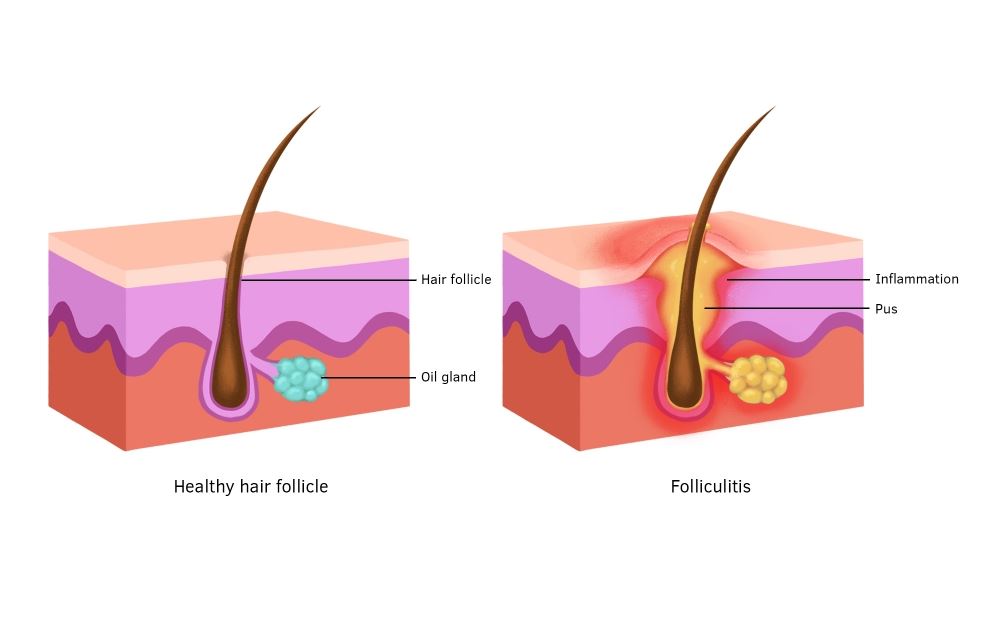 Viêm nang lông là gì